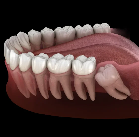 Dental illustration showing a wisdom tooth being removed from the back of the mouth