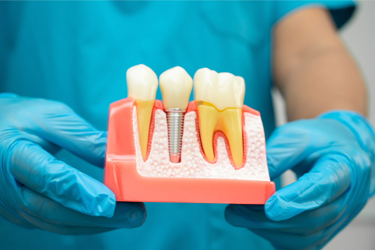 Front Tooth Replacement: Are Dental Implants the Right Choice?