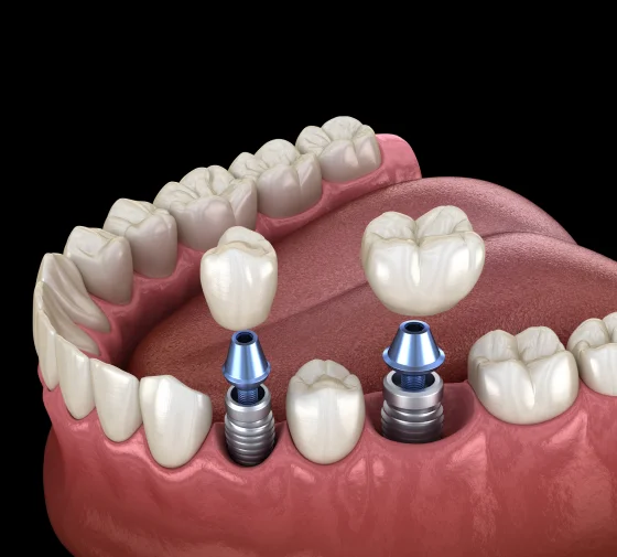 Dental implants supporting replacement teeth along the upper and lower jaw