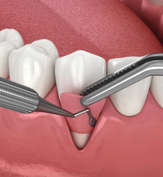 Dental instruments performing a procedure on the gums around a tooth